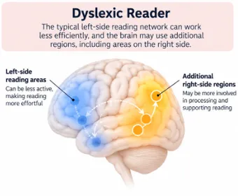 Diagram of a dyslexic reader's brain: the left-side reading network can work less efficiently, so the brain often engages additional right-side regions